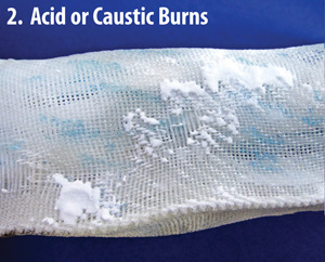Acid or Caustic Burns